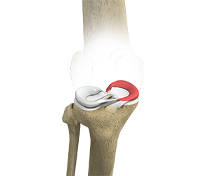 Medial Meniscus Syndrome - Educational Picture