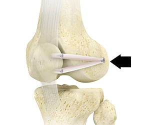 Medial Patellofemoral Ligament Reconstruction - Educational Picture
