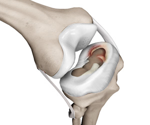 Meniscal Injuries - Educational Picture