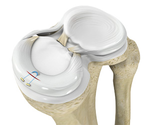 Meniscal Repair Surgery - Educational Picture
