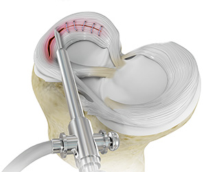 Meniscal Surgery - Educational Picture