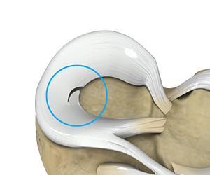 Meniscal Tears - Educational Picture