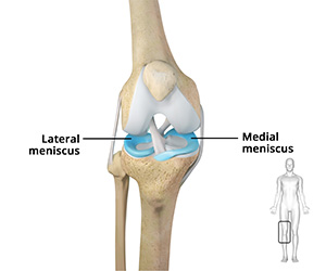 Meniscectomy - Educational Picture