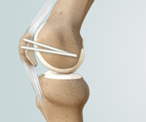 MPFL Reconstruction - Educational Picture
