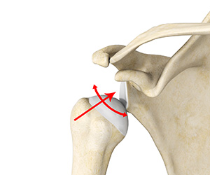Multidirectional Instability of the Shoulder - Educational Picture