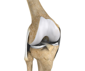Multiligament Instability - Educational Picture
