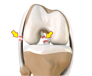 Multiligament Knee Injuries - Educational Picture