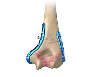 ORIF of the Humerus Fractures - Educational Picture