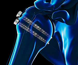 ORIF Proximal Humerus Fracture - Educational Picture