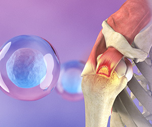 Orthobiologic Treatments for Rotator Cuff Tears - Educational Picture