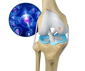 Orthobiologics for the Knee - Educational Picture