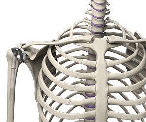 Outpatient Shoulder Replacement - Educational Picture