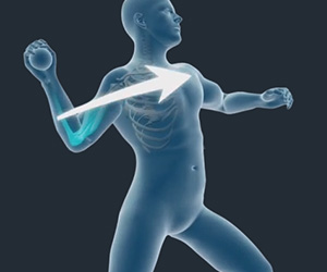 Overhead Athlete's Shoulder - Educational Picture