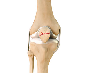 Patella Fracture - Educational Picture