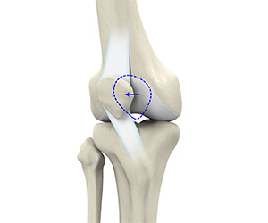 Patellar Instability - Educational Picture
