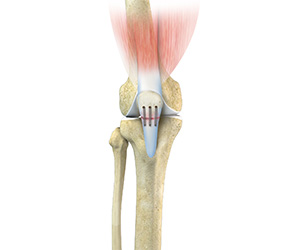 Patellar Tendon Repair - Educational Picture