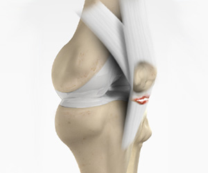 Patellar Tendon Rupture - Educational Picture