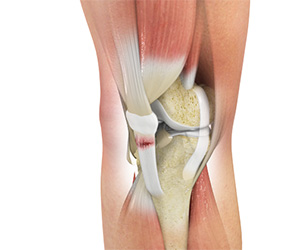 Patellar Tendon Tear - Educational Picture