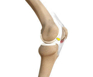 Patellar Tendonitis - Educational Picture