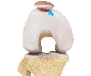 Patellofemoral Arthritis - Educational Picture