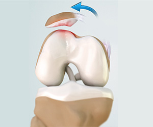 Patellofemoral Instability - Educational Picture