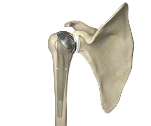 Patient-Specific Shoulder Replacement - Educational Picture