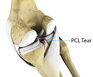 PCL Injuries - Educational Picture