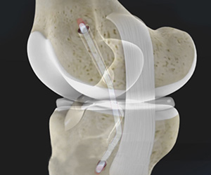 PCL Reconstruction - Educational Picture