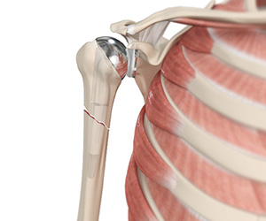 Periprosthetic Shoulder Fracture - Educational Picture