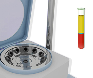 Platelet-Rich Plasma (PRP) for the Elbow - Educational Picture