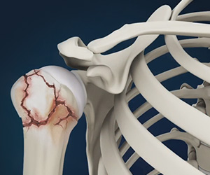 Proximal Humerus Fractures - Educational Picture