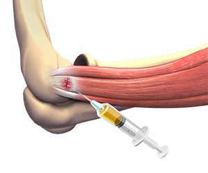 PRP for Tennis Elbow - Educational Picture