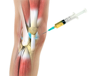 Platelet Rich Plasma (PRP) Injections for the Knee - Educational Picture