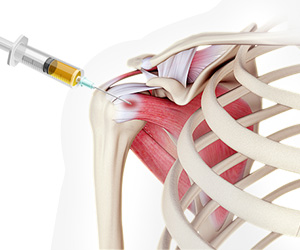 Platelet-Rich Plasma (PRP) for the Shoulder - Educational Picture
