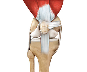 Quadriceps Tendon Repair - Educational Picture