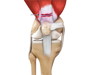 Quadriceps Tendon Rupture - Educational Picture