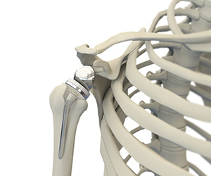Reverse Shoulder Replacement - Educational Picture