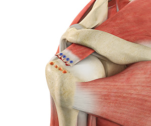 Revision Rotator Cuff Surgery - Educational Picture