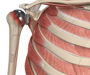 Revision Shoulder Replacement - Educational Picture
