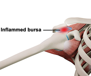 Rotator Cuff Bursitis - Educational Picture