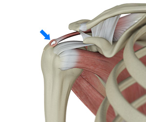 Rotator Cuff Calcification - Educational Picture