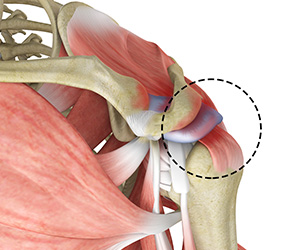 Rotator Cuff Pain - Educational Picture