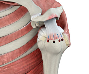 Rotator Cuff Repair - Educational Picture