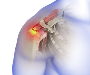 Rotator Cuff Tear - Educational Picture