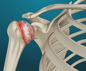 Arthritis of the Shoulder - Educational Picture