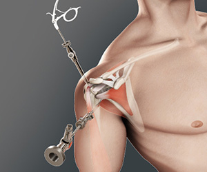 Shoulder Arthroscopy - Educational Picture