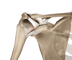 Shoulder Cartilage Restoration - Educational Picture