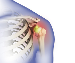 Shoulder Dislocation - Educational Picture