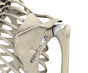 Shoulder Fracture Care - Educational Picture