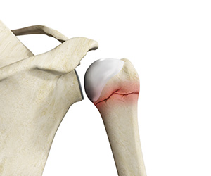 Shoulder Fracture - Educational Picture